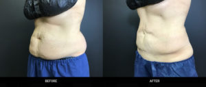 Side-by-side images showing the profile of a torso before and after weight loss, with notable reduction in abdominal fat. the person is wearing blue shorts and has gloves on.