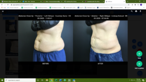 Advanced Skin + Body Aesthetics Med spa, Botox, Facials and more! Two side-by-side images titled "before" and "after" showcasing the abdomen of a person in blue shorts, representing a real patient experience. The left image shows a fuller abdomen; the