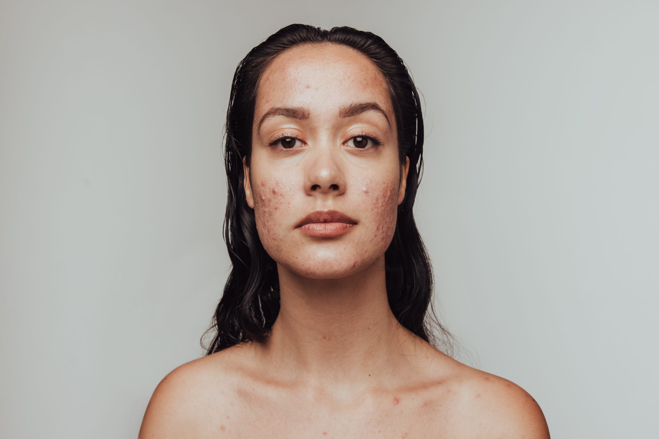 Confident model with severe acne faces forward.