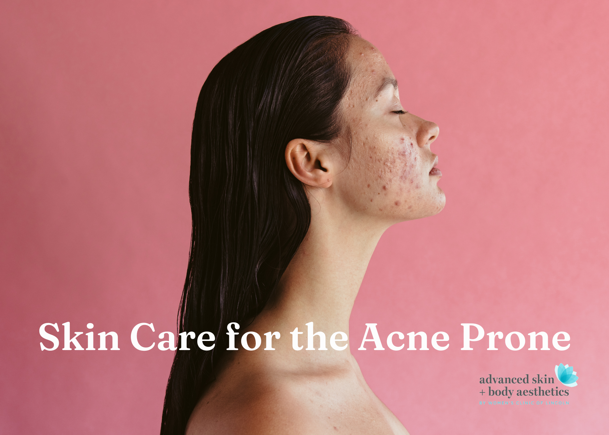 Skin Care for the Acne Prone