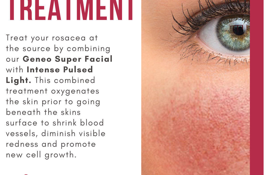 Promotional graphic for rosacea treatment featuring half of a woman's face with clear skin, focusing on her eye. text details a special treatment offer priced at $450, expiring february 28th.