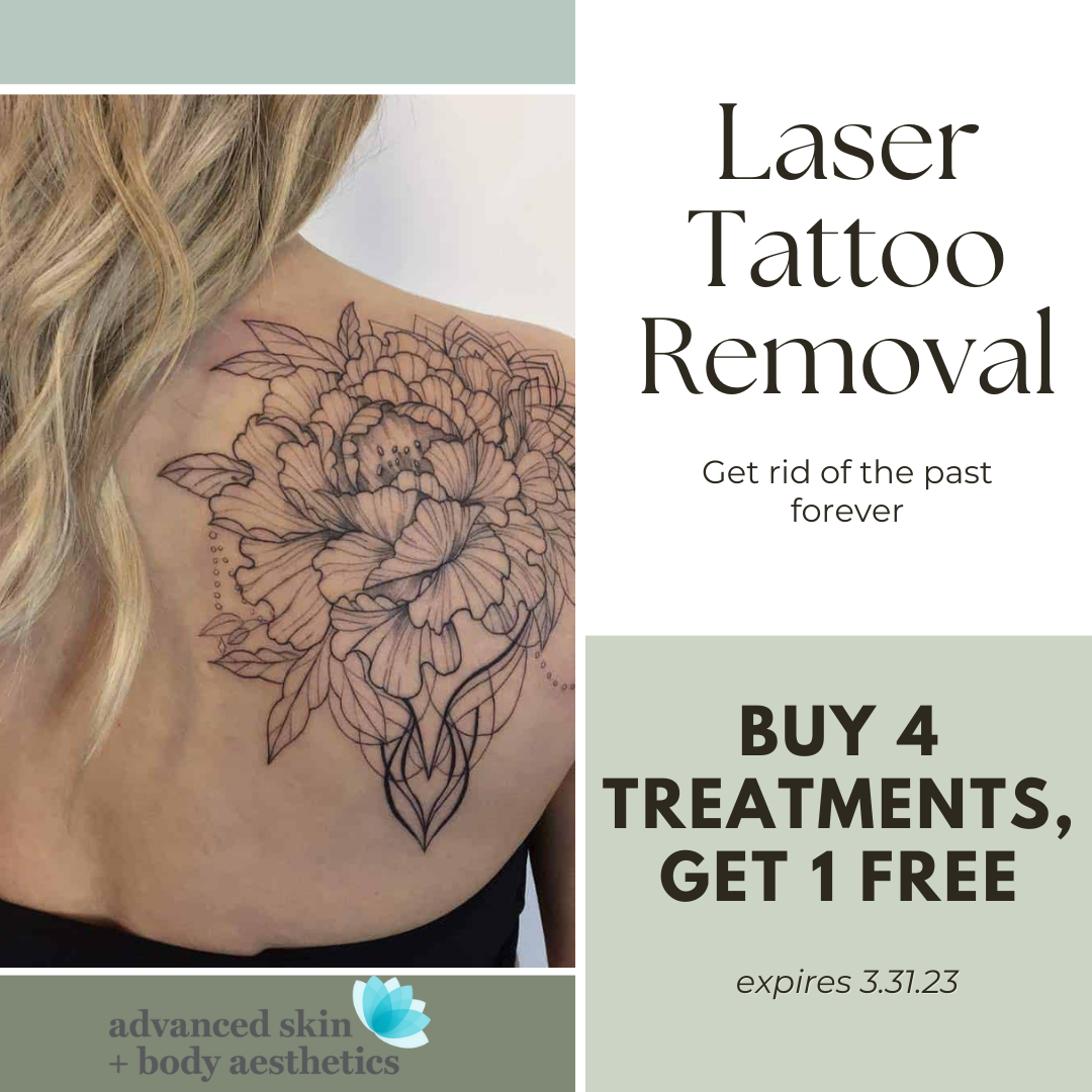 Laser Tattoo Removal 1