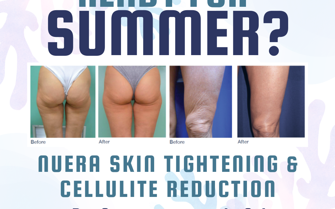 Promotional graphic for skin tightening and cellulite reduction treatments featuring "before" and "after" thigh images. text offers a summer sale with 50% off on buying two treatments, expiring 6/30/23.