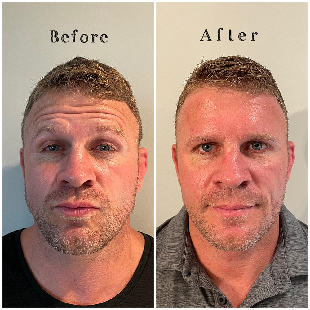 botox lincoln ne before and after
