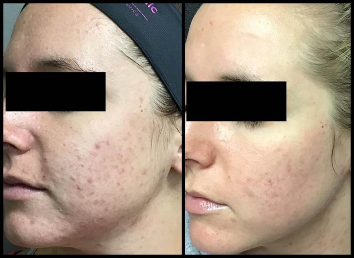 lincoln ne co2 laser fractional resurfacing before and after advanced skin body