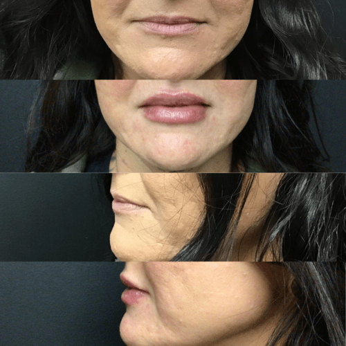 Advanced Skin + Body Aesthetics Med spa, Botox, Facials and more! A composite image showing the lower half of a woman's face before and after a cosmetic procedure. The top two images display fuller, smoother lips and improved skin texture compared to the bottom two images, which show less defined lips and rougher skin.
