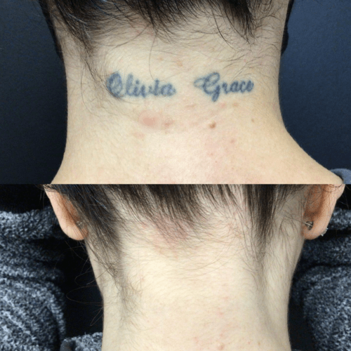 Advanced Skin + Body Aesthetics Med spa, Botox, Facials and more! A two-part image showing a comparison of a tattoo removal process. The top part displays the back of a neck with the tattooed names "Olivia Grace" in cursive script. The bottom part shows the same neck after tattoo removal, with the tattoo no longer visible.