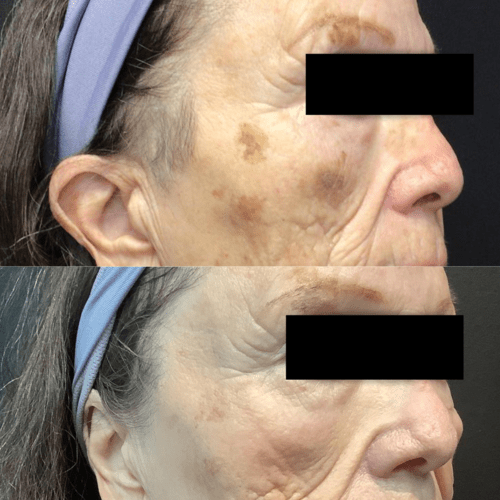 Advanced Skin + Body Aesthetics Med spa, Botox, Facials and more! Side-by-side before and after photos of an older woman’s face, showing skin improvement. She wears a blue headband. The left side has dark spots and more pronounced wrinkles, while the right side shows reduced dark spots and smoother skin. Eyes are blacked out.