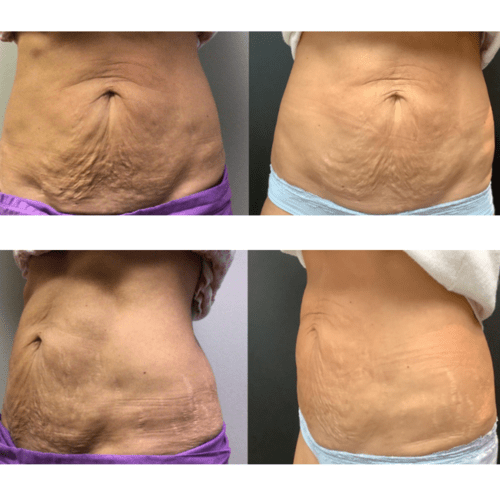 Advanced Skin + Body Aesthetics Med spa, Botox, Facials and more! Before and after photos of abdominal skin, showing reduced sagging and wrinkle improvement. The top row shows the abdomen before the treatment, with noticeable loose skin, while the bottom row shows a firmer and smoother appearance after the treatment.