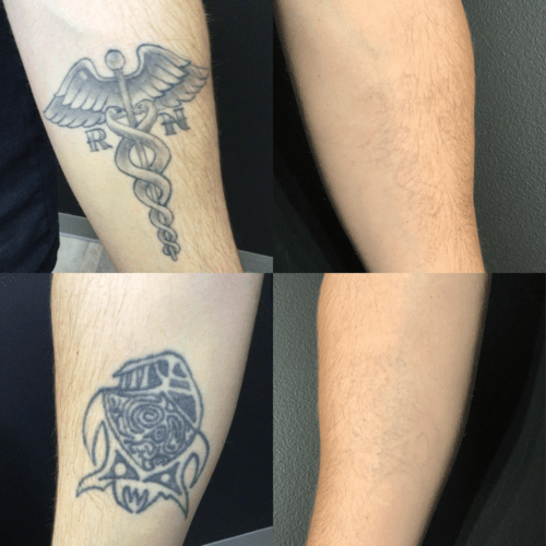 Advanced Skin + Body Aesthetics Med spa, Botox, Facials and more! A four-part image showing before and after laser tattoo removal on two different tattoos on an arm. The top left square displays a caduceus with "RN," and the bottom left features a tribal design. The right squares show the same arm after tattoo removal.